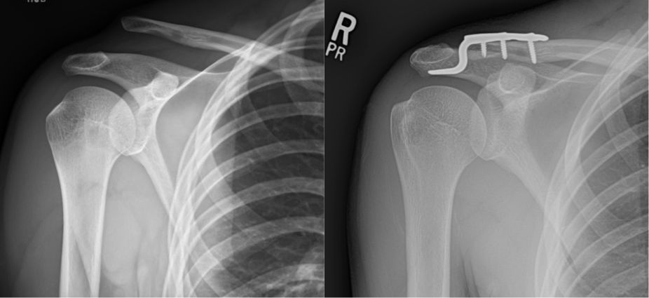 Separated shoulder x ray by Orthopaedic Associates of Muskegon